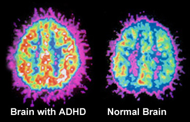 ADHD in the Classroom: Dr. Aletkin Tells Us How to Cope